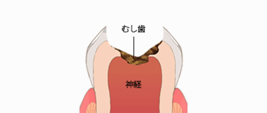 一般的な虫歯治療