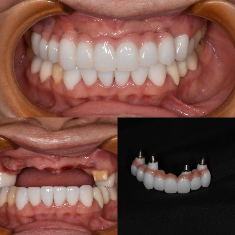 前歯部インプラント症例